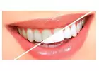 Best Teeth Whitening in Bangalore | Teeth Bleaching Bangalore