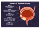 Understanding Bladder Cancer: A Brief Overview and Speciality of Denvax Clinic