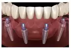 Affordable Dental Implants Near Me
