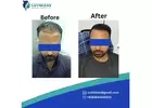 Cutibless | Best Hair Transplant in Bangalore