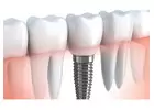 Cheapest Cost for Dental Implants in India
