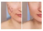 Experience Microneedling Excellence at Birem MD, Beauty & Wellness in McLean, VA