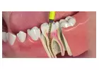 Most Affordable Root Canal Treatment Cost in India