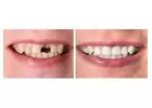 Best Dental Implant in Orchard