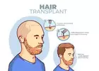 Cutibless: Best Hair Transplant in Bangalore